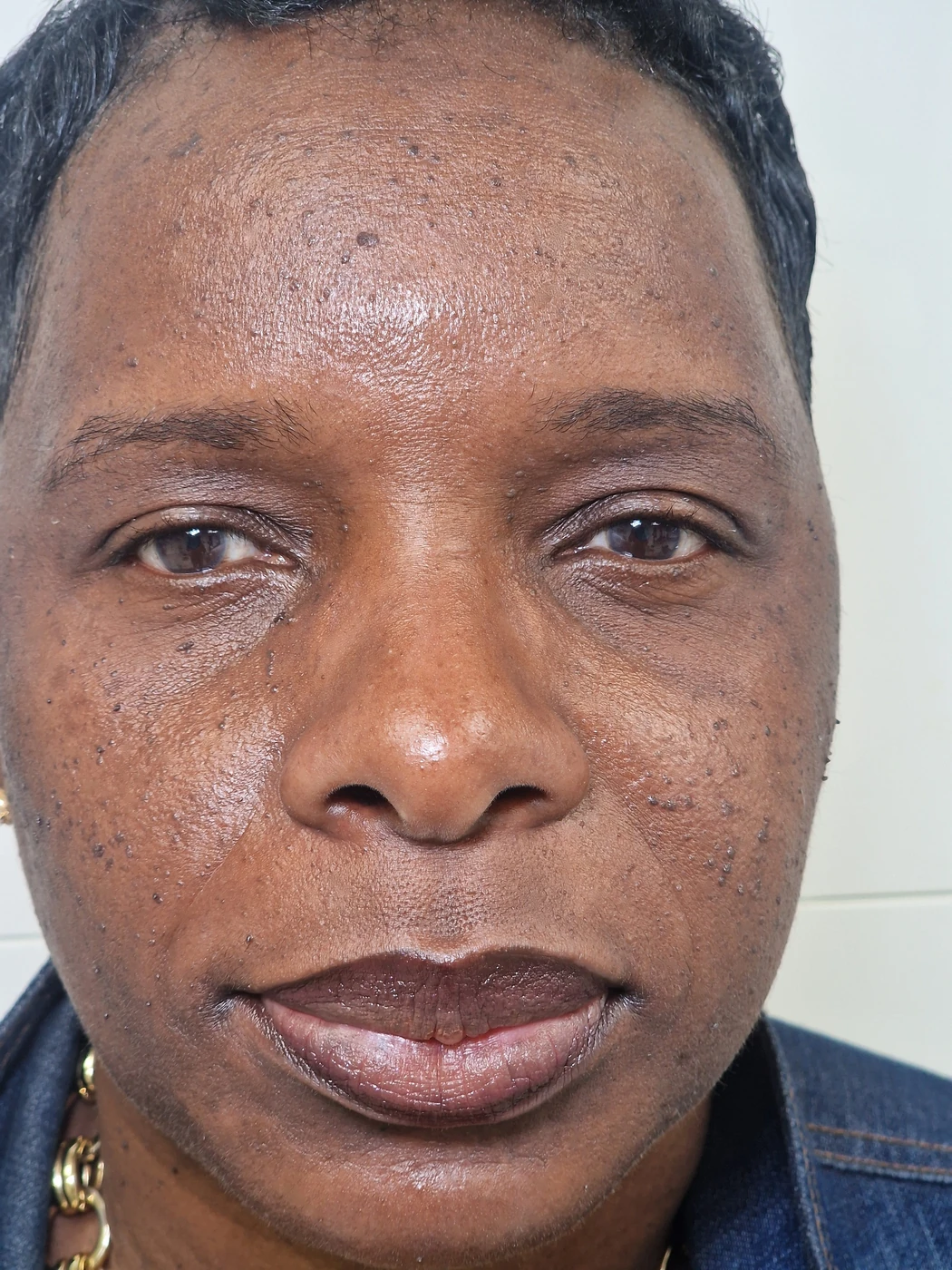 DPN case 01: photograph labelled before treatment