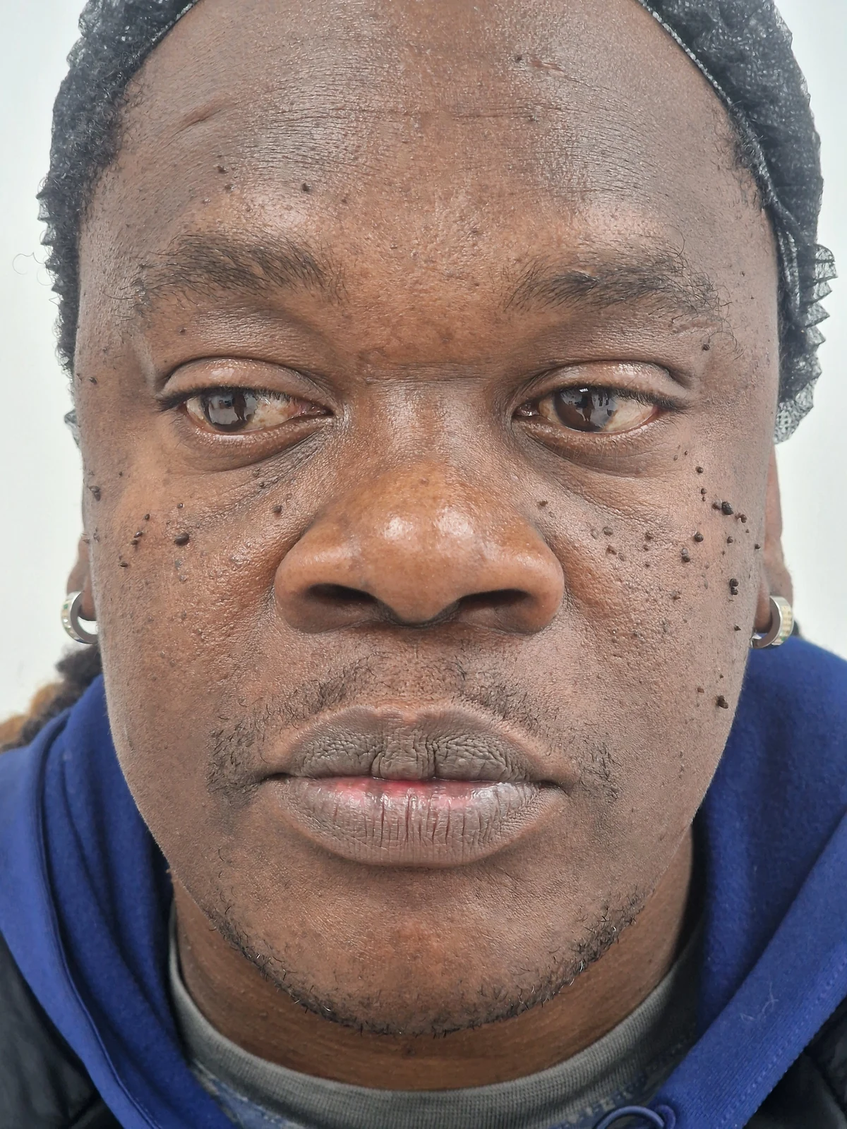 DPN removal case 04: photograph labelled before treatment
