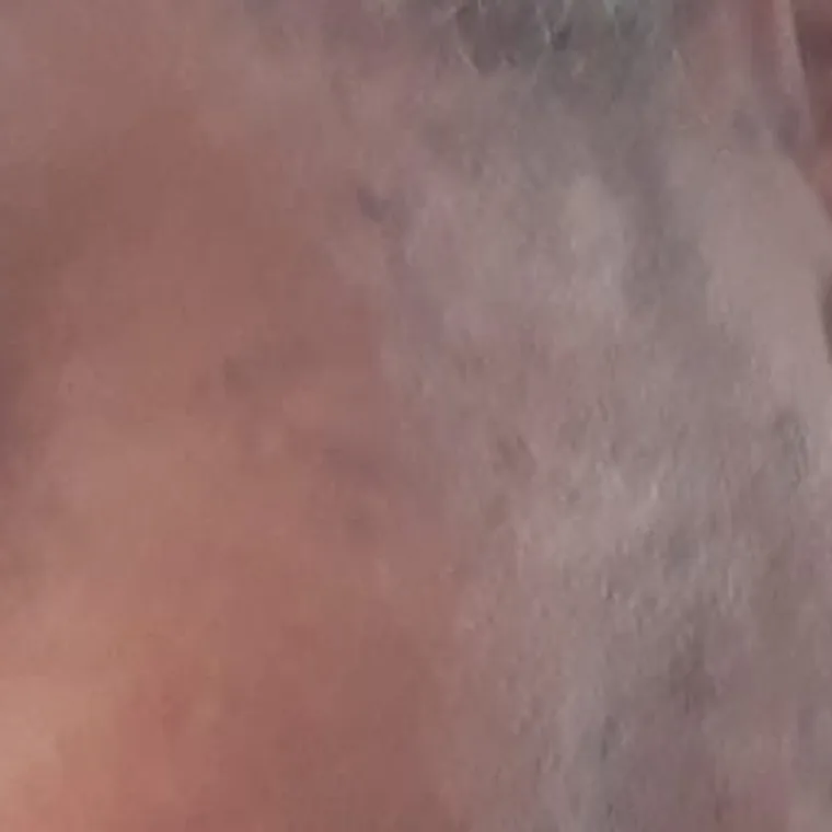 The same client and area after seborrhoeic keratosis removal, client 1