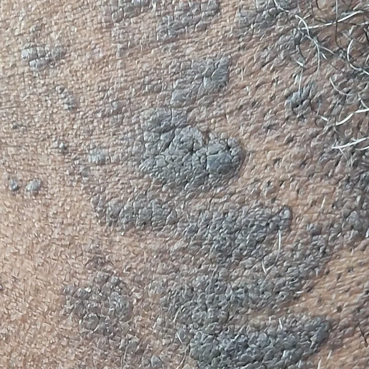Seborrhoeic keratoses before treatment, client 1