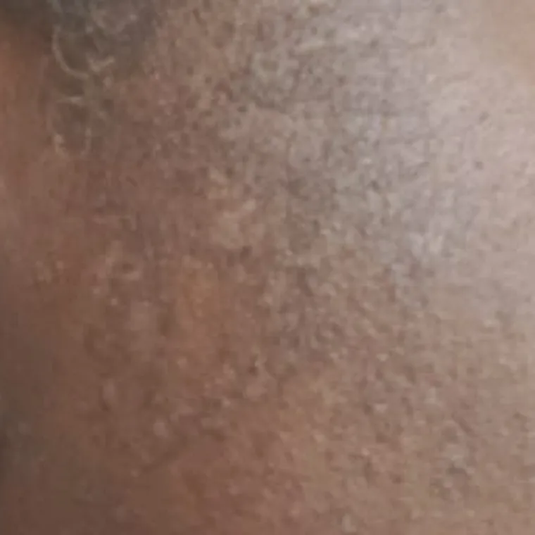 The same client and area after seborrhoeic keratosis removal, client 2
