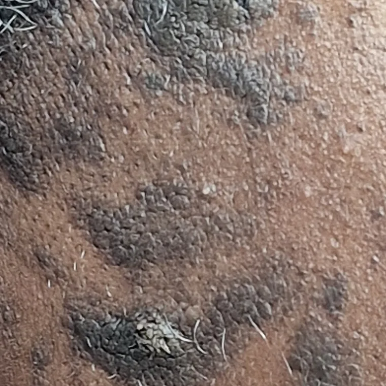 Seborrhoeic keratoses before treatment, client 2