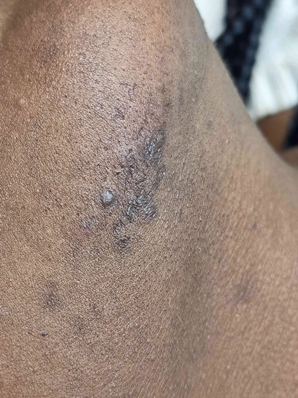 Electrolysis treatment progress photograph from WOB’s hair-removal page