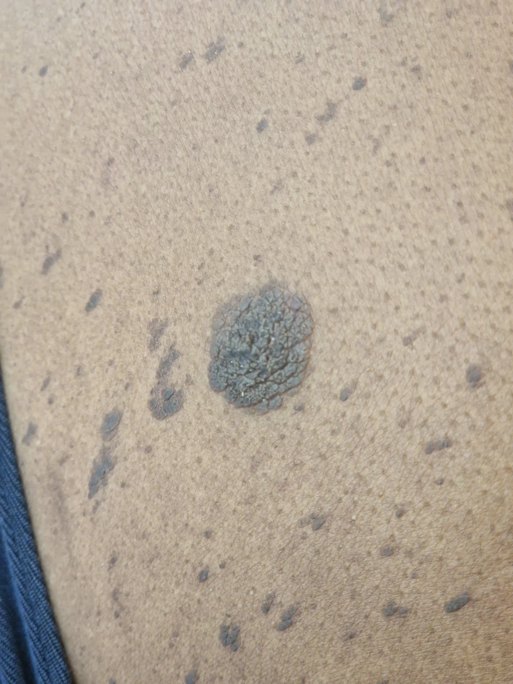 Body photograph supplied in the seborrhoeic keratosis folder