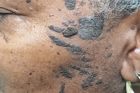 Seborrhoeic keratosis on a client's temple