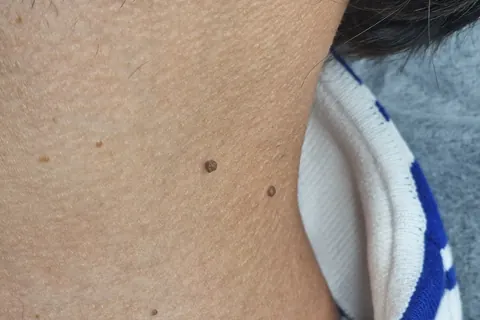 Skin tags on a client's neck